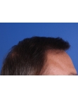 After Hair Transplant&nbsp;Front